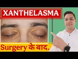 5 Critical Mistakes to Avoid After Xanthelasma Removal Surgery