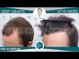 Hair Graft Technique FUE Grafts 3007 (6710 Hairs)