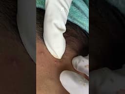 Big Cystic Acne Blackheads Extraction Blackheads & Milia, Whiteheads Removal Pimple Popping #shorts