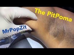 Deep Lipoma in the armpit. Actually a small pitpop with a squeeze! 2 week follow up at end of video