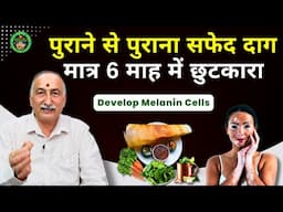 सफेद दाग के घरेलू इलाज || Vitiligo Home Remedies | Leucoderma Ayurvedic Upchar | Ayurvedic Medicines