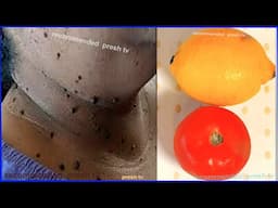 Remove skin tags in 1 night permanently with lemon tomato remedy / skin tag removal home remedies