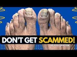 Don't Get Scammed! Avoid Toenail Fungus Treatments That Don’t Work