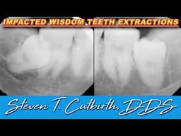 Impacted Wisdom Teeth Extractions - Dental Minute with Steven T. Cutbirth, DDS