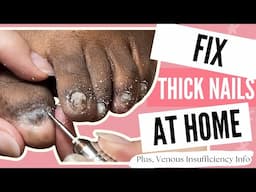 Say Goodbye to Thick Toenails Forever: Easy DIY Solutions That Work!