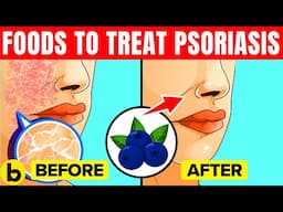 10 Foods That Can Help With Psoriasis