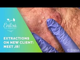 New Client! Many Extractions on JR