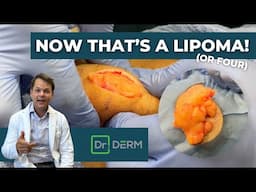 Now THAT'S a Lipoma! (Or Four...) | Dr. Derm