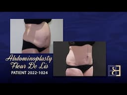 Fleur de Lis Abdominoplasty Post Weight Loss (Patient 2022-1024)