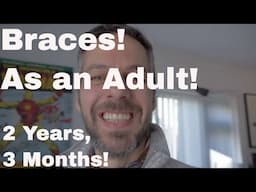 Getting Braces as an adult! (27 Months in!)