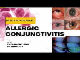 Allergic Conjunctivitis: Classification, Pathophysiology, Treatment & Management Explained