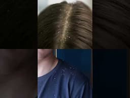 How Dandruff is formed...