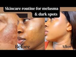 How I cleared my Melasma & Hyperpigmentation