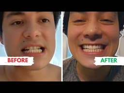 My INVISABLE BRACES experience! (Invisalign)