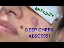 Deep cheek abscess drained! Purulence removed, pressure relieved, patient happy!