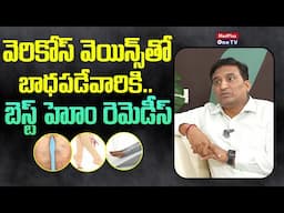 Home Remedies For Varicose Veins | Varicose Veins Treatment | Dr.Srikanth Raju @MedPlusONETV