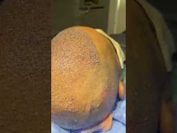 Hair transplant  post op at Vinci Hair Clinic #vincihairclinic #shorts