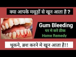 Bleeding gums treatment & home remedy