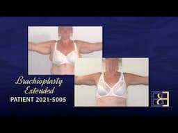 Extended Brachioplasty Assisted by VASER Liposuction (Patient 2021-5005)