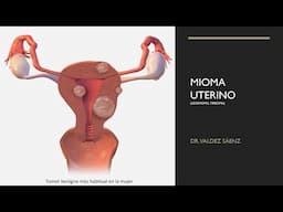 Mioma uterino (leiomioma, fibroma)