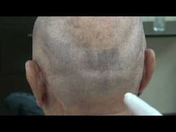 Hair Loss Treatment for Men | [Type of transplant] (# Hair grafts)