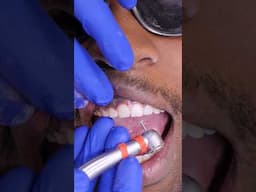 How Tooth Shaving Works