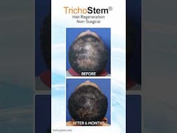 Hair Loss Treatment for Women without Minoxidil or Spironolactone #thickerhair