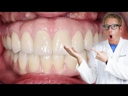 How To Clean All-On-4 Permanent Implant Dentures. Maintain Fixed Hybrids or Teeth-In-A-Day