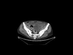 Small bowel obstruction due to femoral hernia