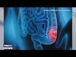 The Doctor Is In: Lower your risk of colon cancer