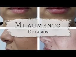 Mi Aumento de Labios | Vivanta Tenerife