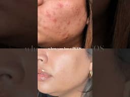 Healing #pcos acne from within.