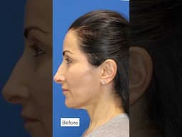 7-Month Facelift Update! Dr. Karam's WIFE'S Facelift Transformation!