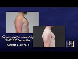 Gynaecomastia: VASER Liposuction + Gland Excision [BB grade 2a] {Patient 2022-7010} Before & After