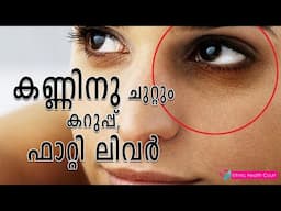 മുഖത്തുള്ള ഈ ലക്ഷണങ്ങൾ ഫാറ്റി ലിവറിൻ്റെ ലക്ഷണങ്ങൾ.| Ethnic Health Court