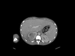 pyelonephritis with abscess & renal vein thrombus