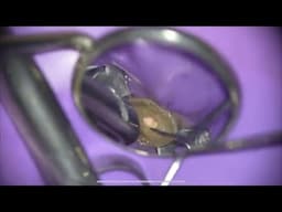 Live Root Canal Treatment (Premolar Retreatment)