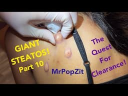 25 minutes of pops! STEATOS, blackheads, cysts extractions! Getting closer to clearance!