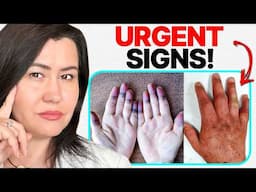 10 URGENT SIGNS of Mixed Connective Tissue Disease (MCTD)